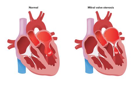 lv volume mitral stenosis|mitral ventricular stenosis.